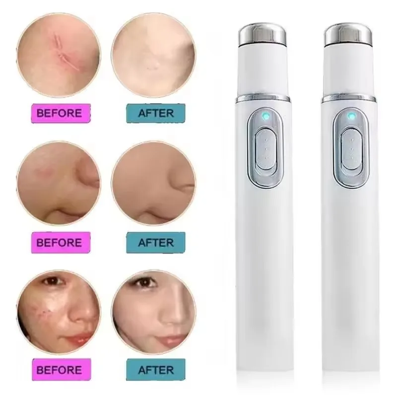 Терапия синим светом, ручка от – обзор и цена Acne Light Therapy Pen